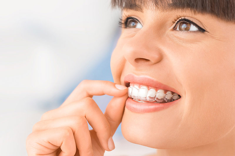 Clear Aligners in Tampa